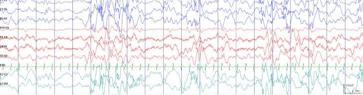 medically refractory infantile spasms Inter-ictal EEG Previously normal until 3 months old Initial seizure