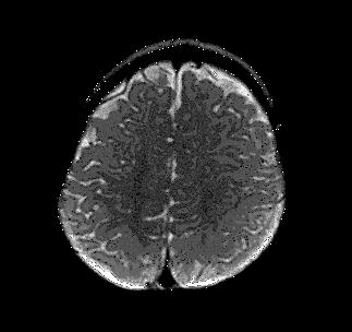 hemiparesis Concordant MRI and PET abnormalities Recommended left frontal
