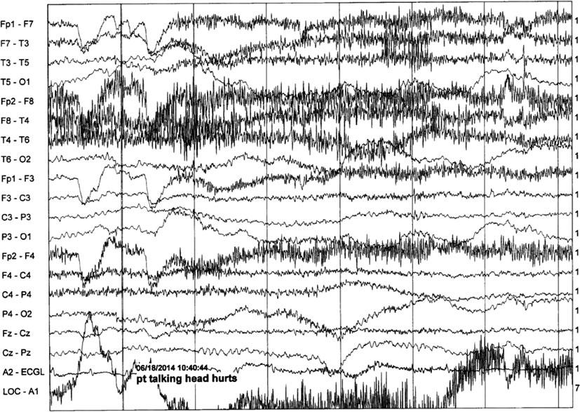 2 EEG Instrumentation, Montage, Polarity, and