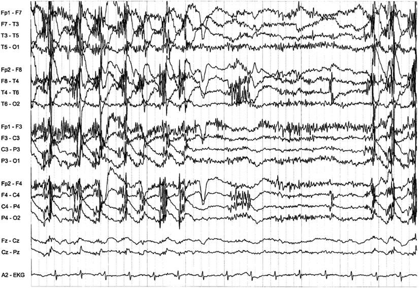 2 EEG Instrumentation, Montage, Polarity, and Localization 29 Fig. 2.20 Rhythmic myogenic artifact is seen during chewing Fig.