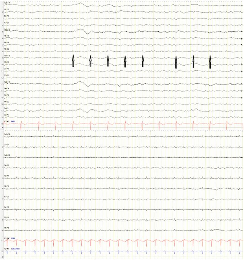 32 K. Tufenkjian Fig. 2.24 ECG artifact. Small sharp transient can be seen time locked to the ECG QRS potentials.