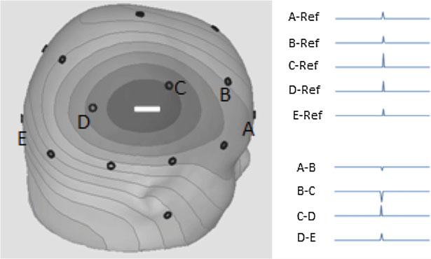 2 EEG Instrumentation, Montage, Polarity, and Localization 19 Fig. 2.8 To the left is a representation of a negative potential and its field as recorded from the scalp.
