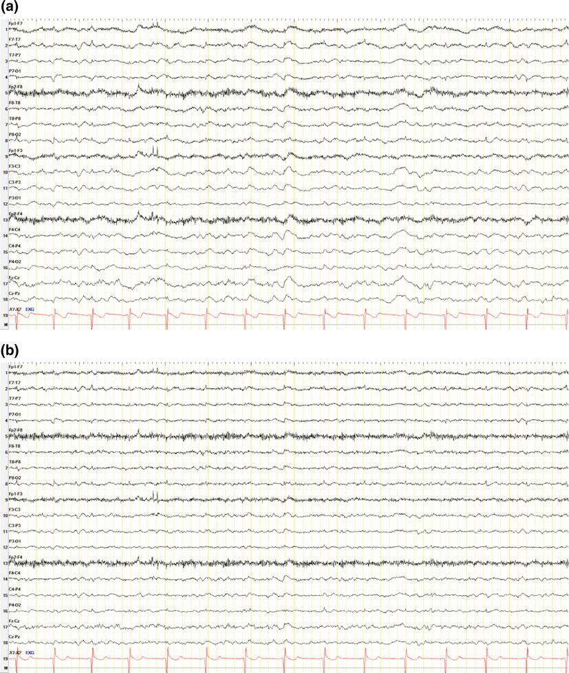 2 EEG Instrumentation, Montage, Polarity, and Localization 21 Fig. 2.11 a EEG with the low-frequency filter set to 1 Hz. b Same EEG with the low-frequency filter changed to 2 Hz.