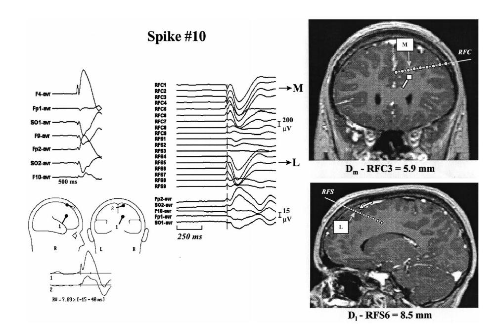 Merlet and Gotman 1999 28 scalp EEG (separate recordings) ; during SEEG: 8 scalp EEG for matching epileptic spikes; Spikes modelled by 1 to 3 dipoles Distance