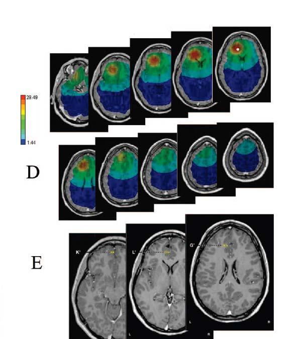 Gavaret et al 2006: frontal epilepsy 64