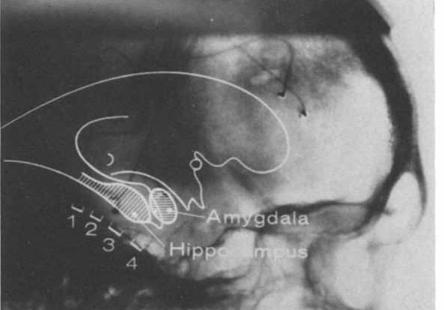 Alarcon et al 1994 Simultaneous scalp EEG foramen ovale