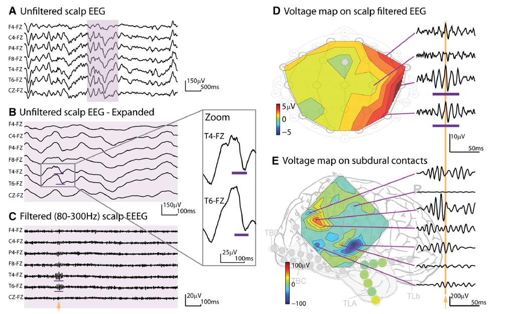 High frequency oscillations Rampp et al 2010 simultaneous subdural/meg :
