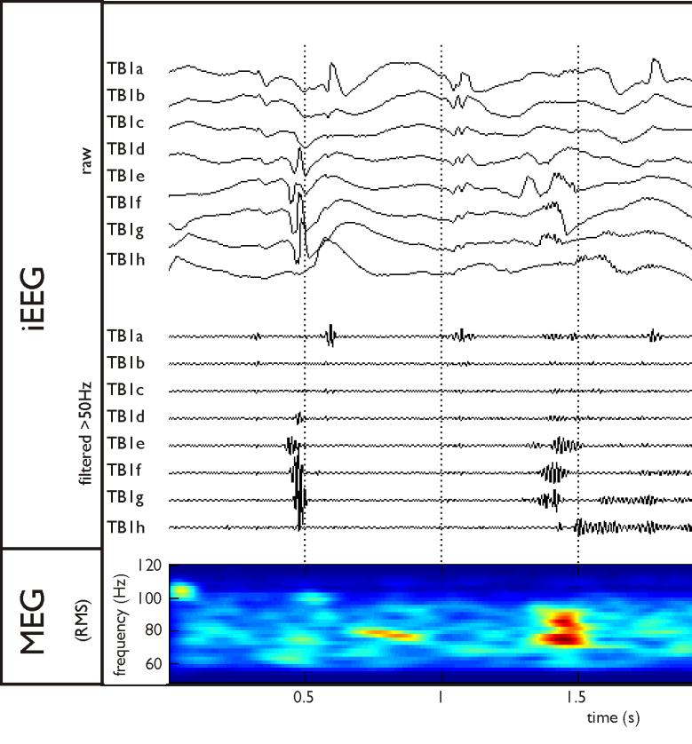 ECoG/EEG: Ripples fast ripples (100-300Hz) can be seen on surface EEG Recent