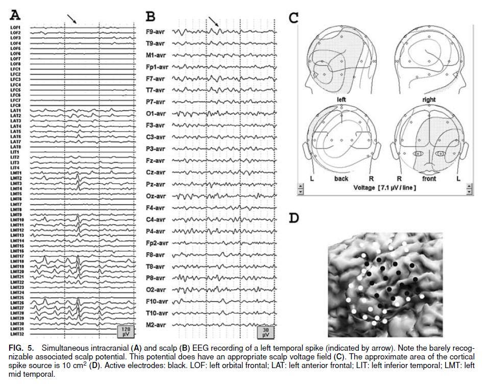 Cooper revisited Tao et al 2005: 10 cm2 for detectability in EEG Oishi et al 2002: 3 cm2