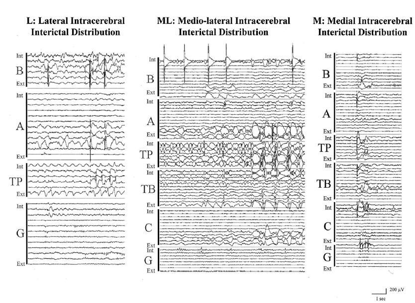 Gavaret et al 2004: temporal epilepsies 64