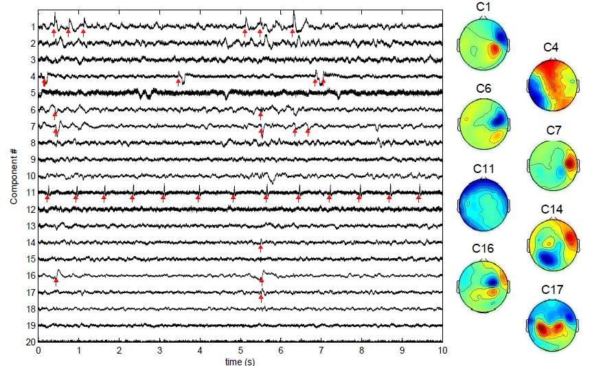 MEG ICA networks (1) Extraction of epileptic components from surface recordings