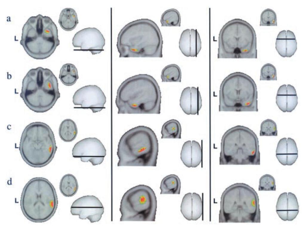 Lantz et al 2001 22 scalp EEG recorded simultaneously with subdural electrodes Lantz et al 1996, 1997 Epifocus source