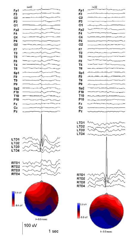 Deep structures: EEG Wennberg et al 2011 Spikes