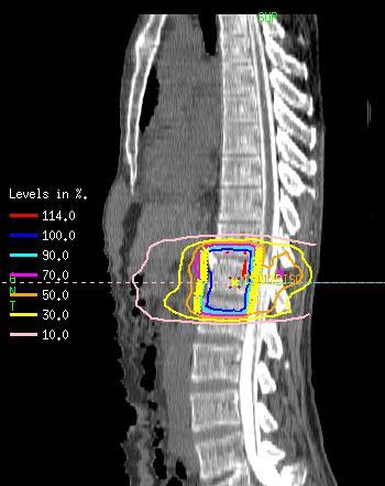 SBRT For Spinal