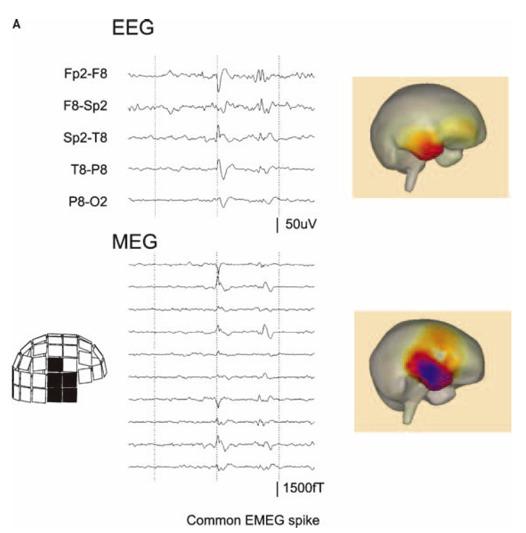 EEG and MEG
