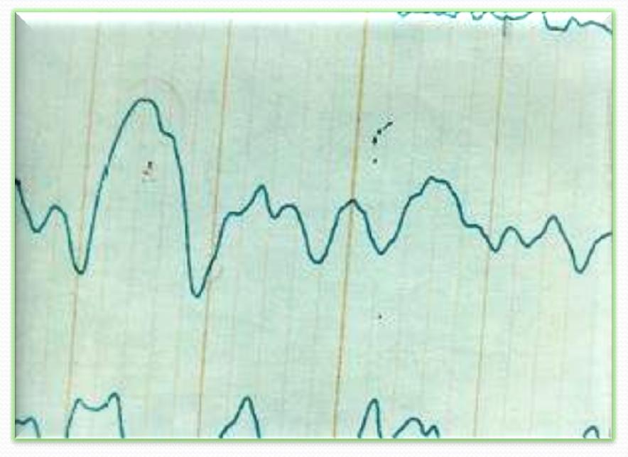 POLYMORPHIC DELTA ACTIVITY Polymorphic delta activity The EEG