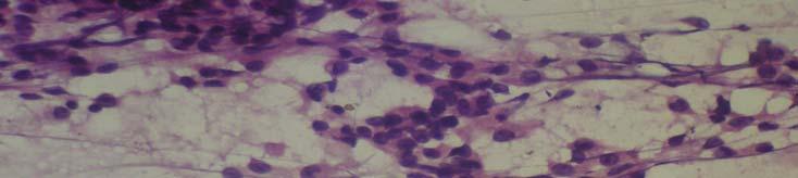 . 59 Figure 2. High power cytology from a FNA of the ulcerating mass.