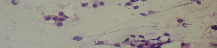 cytological features of malignancy. Figure 3. Cut surface of resected specimen.