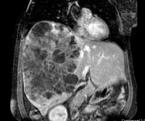 MRI liver