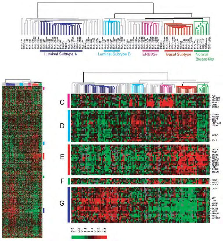 Hierarchical Clustering Using Intrinsic Gene Sets ERBB2 115 tumor tissues 7 nonmalignant tissues