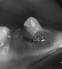 Tooth Resorption Tooth resorption Stage 1 (TR 1): Mild dental hard tissue loss (cementum or cementum and enamel).