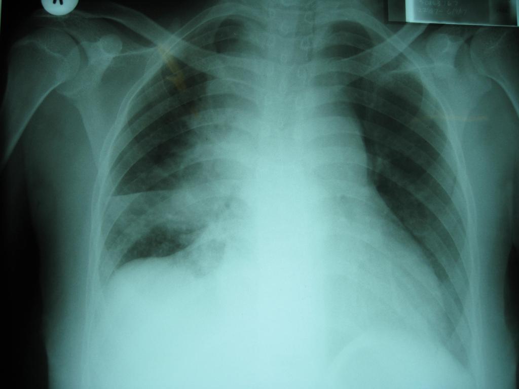 Pulmonary TB-