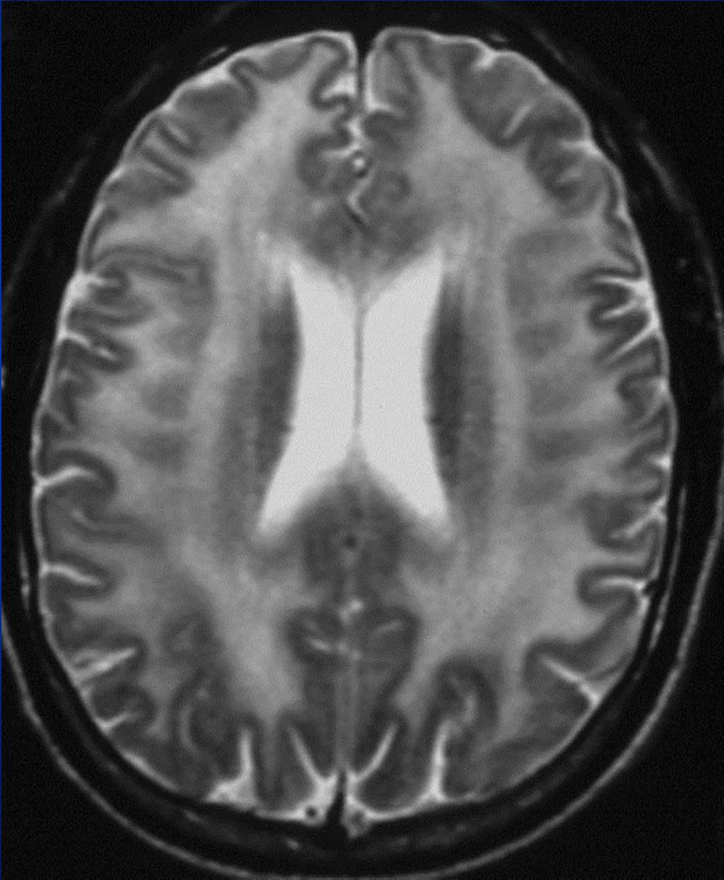 MRI: Diffuse