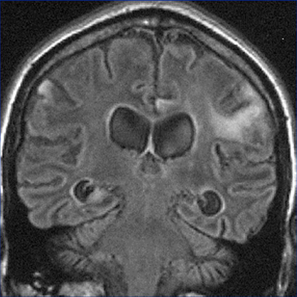 Cerebral CD8+ lymphocytosis