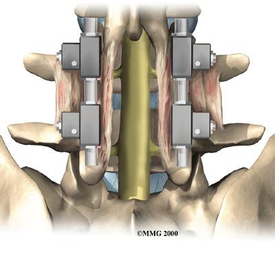 The fusion procedure is recommended when a spinal segment has become loose or unstable. The main surgical procedure used to treat spinal stenosis is lumbar laminectomy.