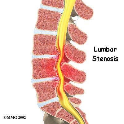 Introduction According to the North American Spine Society (NASS), spinal stenosis describes a clinical syndrome of buttock or leg pain.