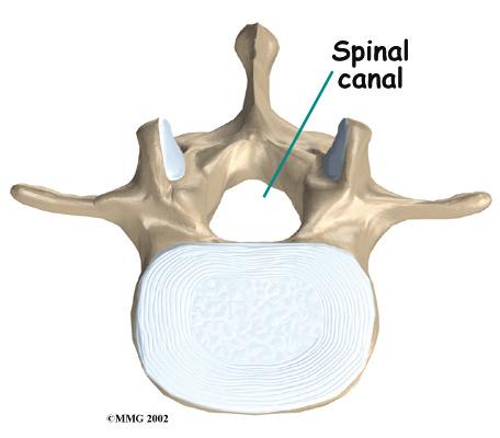 The spinal canal is the hollow tube formed by the bones of the spinal column. Anything that causes this bony tube to shrink can squeeze the nerves inside.