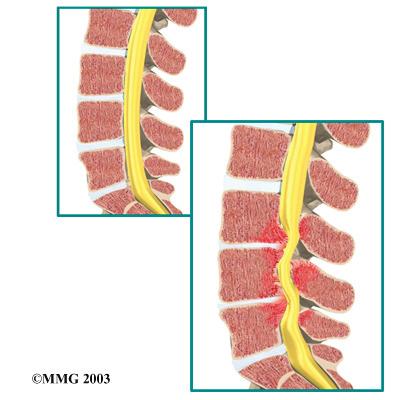 (congenital) a spinal canal that is narrower than normal. They may not feel problems early in life. However, having a narrow spinal canal puts them at risk for stenosis.