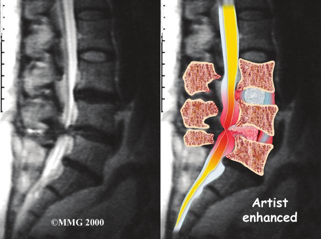 The images can show if degeneration has caused the space between the vertebrae to collapse. X-rays may also show any bone spurs sticking into the spinal canal.