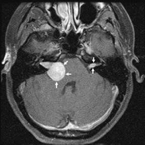 NF2 Bilateral Vestibular Schwannoma Arch Otolaryngol Head Neck Surg.