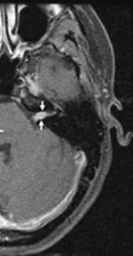 the superior branch of the vestibular nerve." Laryngoscope. 2007;117(12):2087-92. Data show IVN tumors twice as common as SVN, Bedside (caloric) tests sup. vest. nerve J Laryngol Otol.