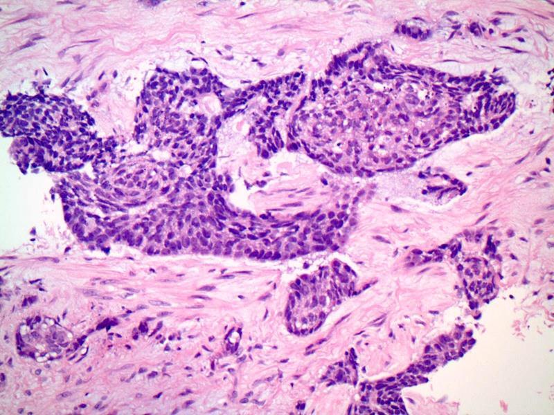 Transbronchial biopsy Diagnosis: Basaloid squamous carcinoma Basaloid Squamous Carcinoma Squamous carcinoma with basaloid morphology At least focal intercellular bridges and individual cell