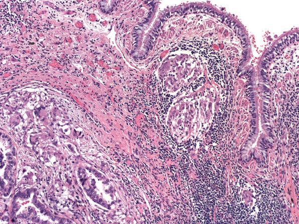 Adenocarcinoma with sarcoid-like reaction Sarcoid-like reaction in hilar lymph nodes Sarcoid-Like