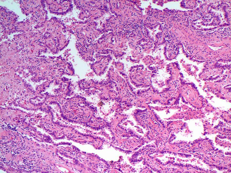 Diagnosis Small cell carcinoma with a possible component of non-small cell carcinoma (mixed small cell carcinoma) Another example 77 year old woman never smoker 2007: Stage 1