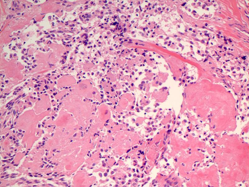 Diagnosis Metastatic medullary thyroid carcinoma Metastatic Carcinoma Don t forget to think about metastasis in any lung FNA Knowledge of