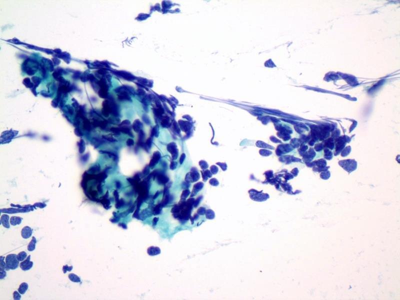 Carcinoid Neoplasm with Crush Artifact Flow Cytometry 1