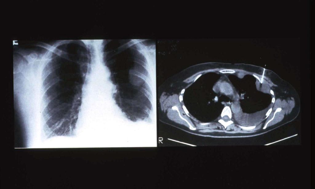 Primary Adenocarcinoma Pleural effusion Adapted from Slide