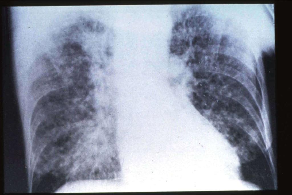 Bronchiolo alveolar carcinoma Multiple, bilateral pulmonary nodules