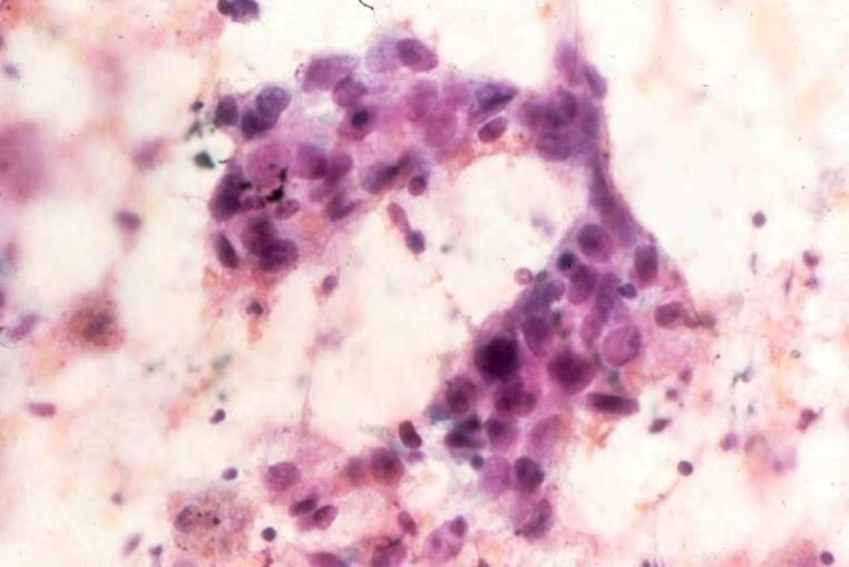 LUNG CYTOLOGY Squamous cell carcinoma Keratinizing type Isolated