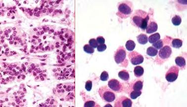 LUNG CYTOLOGY
