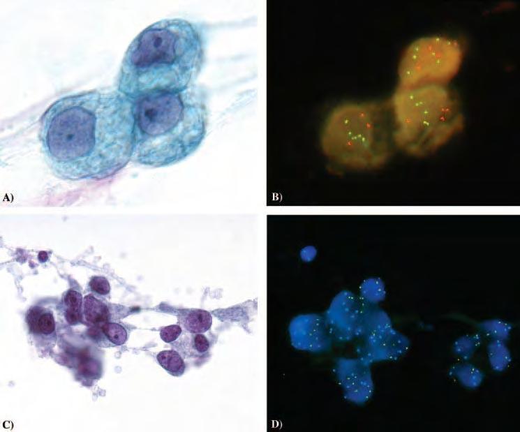 7p12 EGFR (red) 8q24 MYC (gold) Equivocal respiratory cytology is a common diagnostic dilemma to both cytopathologists and clinicians.