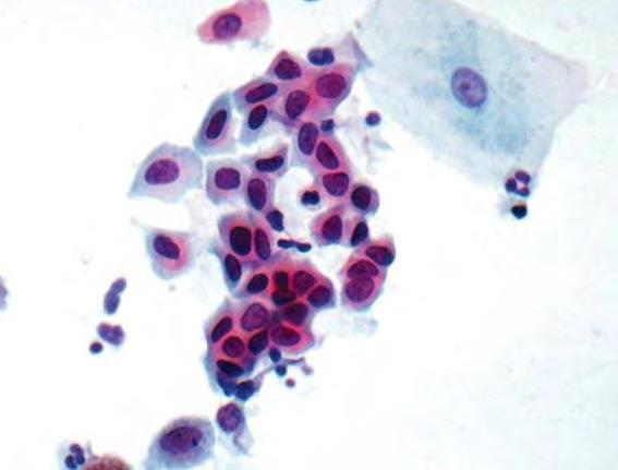 LUNG CYTOLOGY