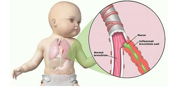 No. 14: Is bronchiolitis contagious? Yes. Caused by an infection that affects small airways leading to the lungs, bronchiolitis is most often found in infants and young children.