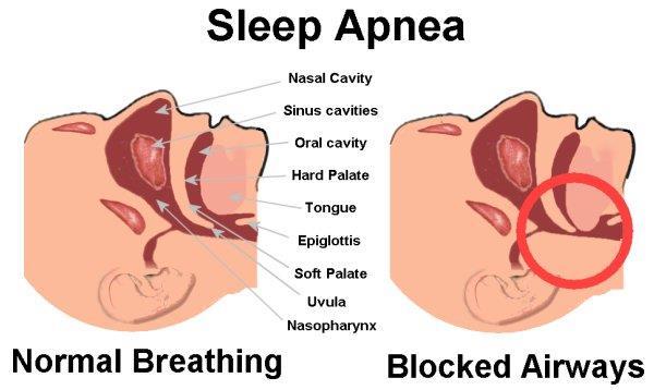 What Happens? When you stop breathing during sleep due to sleep apnea, the balance of oxygen and carbon dioxide in the blood is upset.