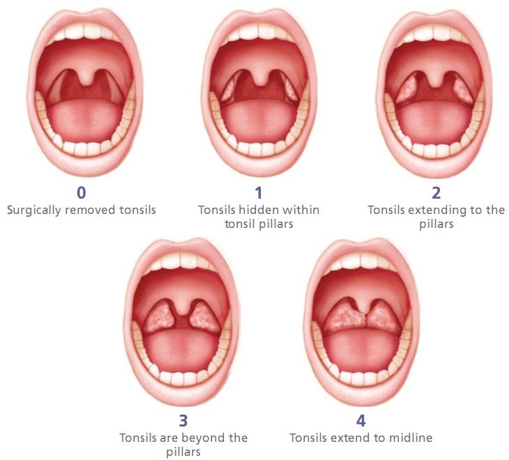 Oral cavity Exam Retrognathia High arched