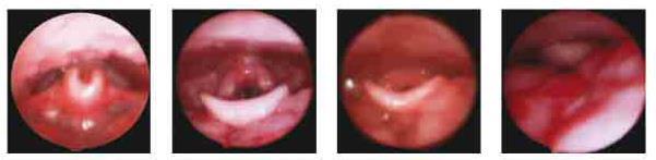 Grading system Tongue base 0 = No obstruction (complete view of vallecula) 1 = 0-50% Obstruction (vallecula not visible) 2 = 50%-99% Obstruction (epiglottis not